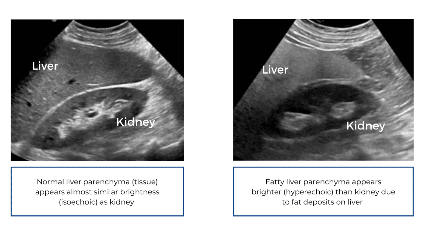 Liver Parenchyma