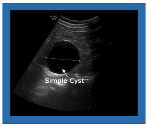 cyst