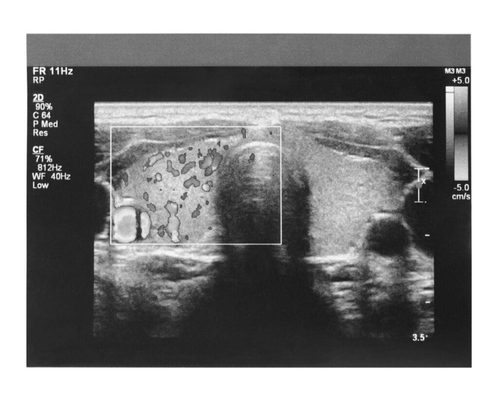 Ultrasound scan imaging of thyroid gland
